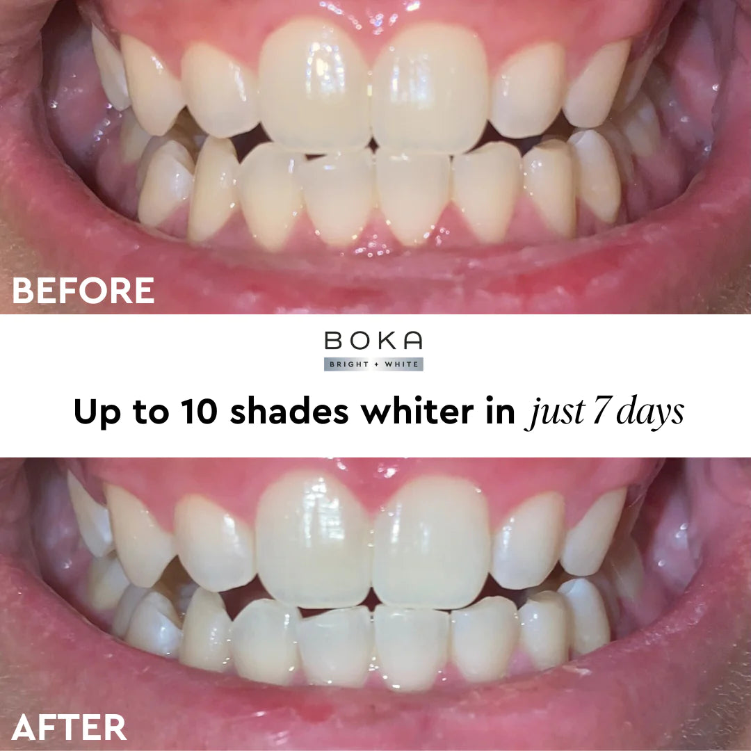 Boka, fljótvirkt tannhvíttunarsett